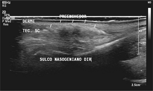 Soft tissue ultrasound of the face showing hyperechoic deposits with &ldquo;comet tail artifact&rdquo; reverberation in the nasolabial folds