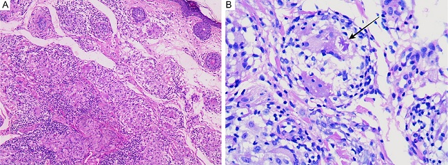 A - Interstitial lymphohistiocytic inflammatory infiltrate with formation of epithelioid granulomas, without necrosis, associated with well-developed lymphocytic mantles (Hematoxylin & eosin 20x). B - Asteroid body (arrow) surrounded by epithelioid granuloma with lymphohistiocytic infiltrate (Hematoxylin & eosin 40x)