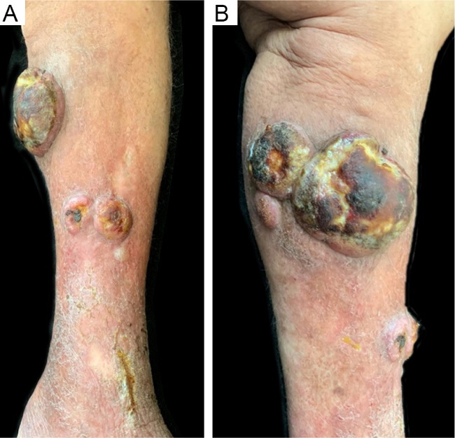 A: Left leg: vegetating nodules and tumors, sometimes covered by a blackened crust. B: Greater detail: medial face