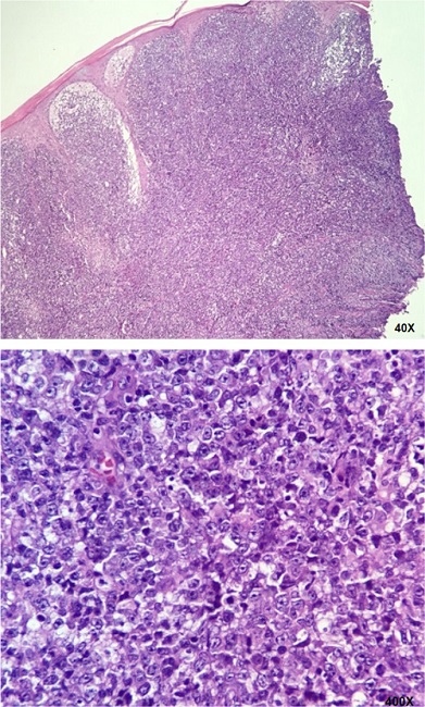 Superficial and deep dermis with presence of dense diffuse lymphocytic infiltrate of large cells, sometimes with irregularly contoured nuclei, and abundant mitotic figures (Hematoxylin & Eosin 40x, 400x)