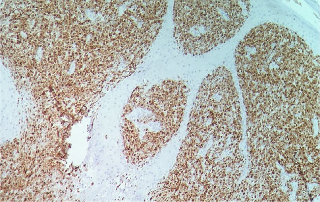 Immunohistochemistry: MUM-1 positive