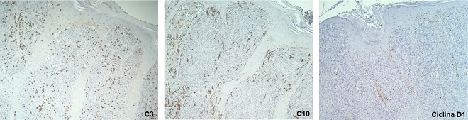 Immunohistochemistry: CD3, CD10, and cyclin D1 negative