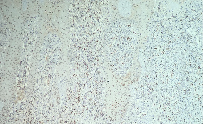 Immunohistochemistry: C-MYC positive in 30% of cells
