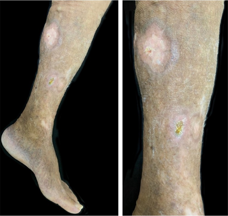Scar dyschromic areas after chemotherapy with R-CHOP regimen