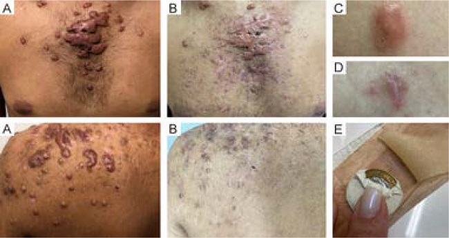 Este paciente apresentou lesões queloides de acne apesar das
								tentativas de tratamento com injeções de triancinolona; referiu dor
								durante o procedimento e piora clínica após alguns meses. B
									- Seis meses após curativos oclusivos de hidrocoloide,
								com diminuição da altura e sintomas do queloide; os queloides
								restantes agora são amolecidos o suficiente para receber injeções.
									Algoritmo: A análise do Passo A - demosntra
								queloides extensos. Passo S - Começou com hidrocoloides
								para suavizar os queloides antes das injeções. C, D -
								Pequeno queloide tratado com curativo de silicone, trocado a cada 10
								dias, com uma moeda embaixo da roupa de pressão para aumentar a
								compressão.