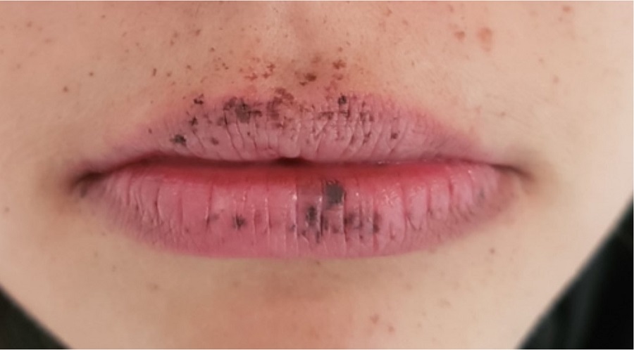 Múltiplas máculas hipercrômicas nos lábios superior e inferior
							(primeira sessão de laser e início do tratamento)
