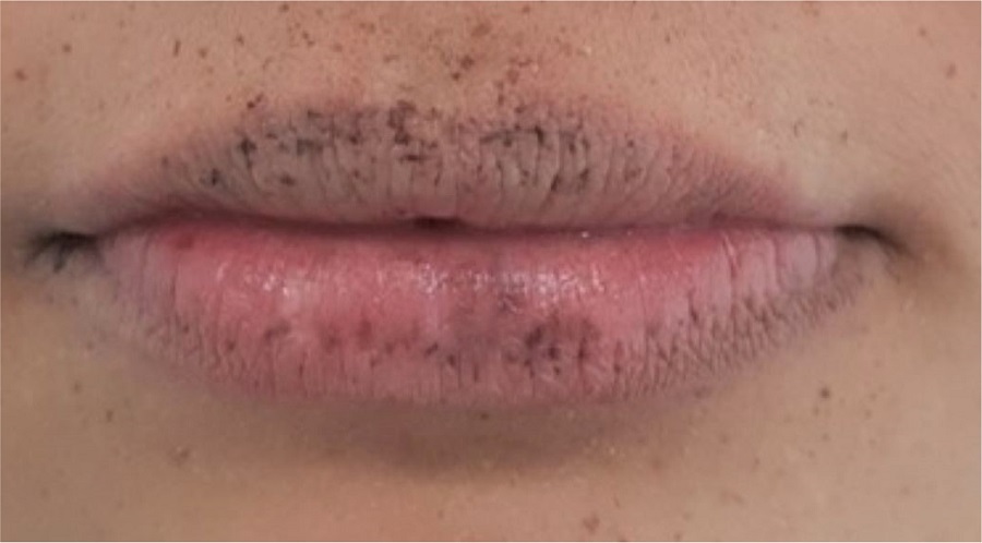 Atenuação na coloração das máculas labiais após a segunda sessão de
							laser (30 dias após o início do tratamento)