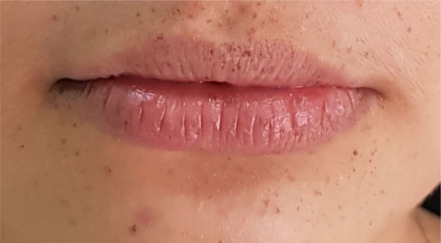 Redução significativa na quantidade das máculas labiais após a
							terceira sessão de laser (60 dias após o início do tratamento)