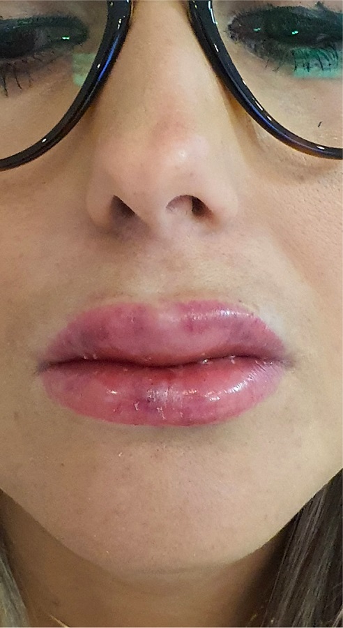 Aspecto edematoso, com equimoses nos l&aacute;bios