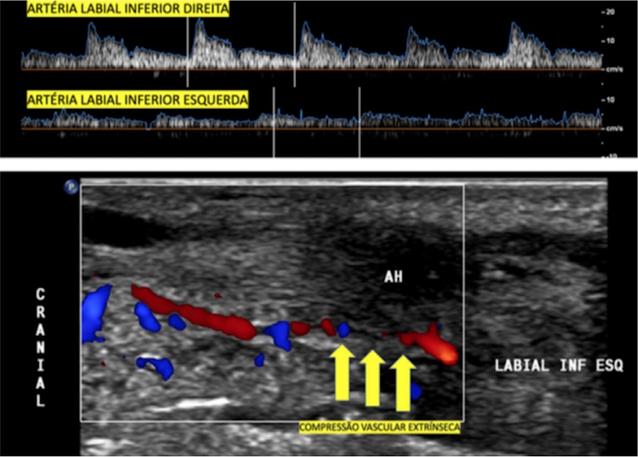 Compress&atilde;o vascular externa da art&eacute;ria labial inferior