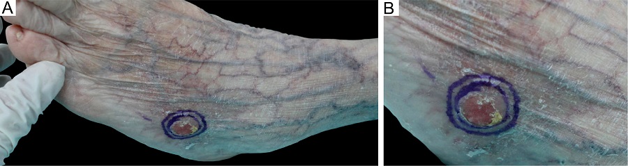 A - Carcinoma espinocelular no p&eacute; esquerdo. B
								- Detalhe da les&atilde;o