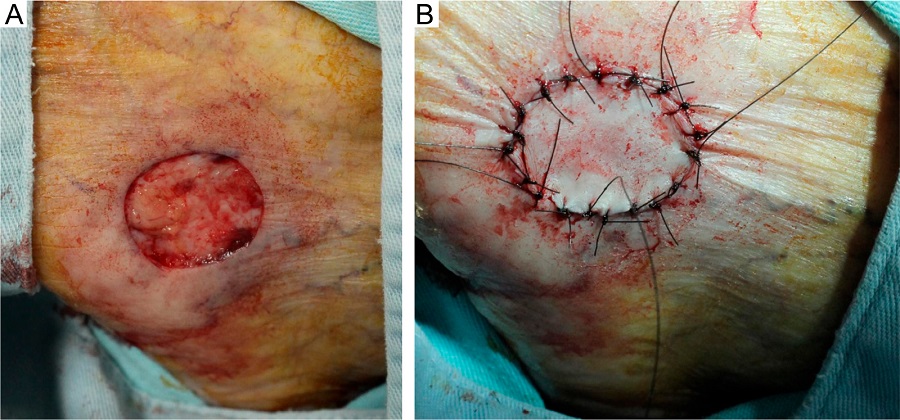 A - Defeito resultante no p&eacute; esquerdo. 2B -
							Enxerto de pele total suturado