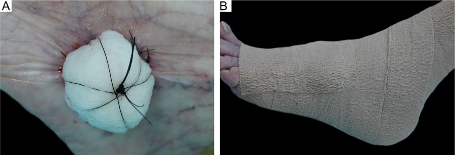 A - Enxertia no p&eacute; esquerdo com curativo de Brown.
								B -Faixa el&aacute;stica sobre o curativo de Brown