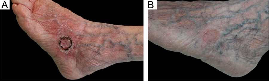 A - Enxertia do p&eacute; esquerdo no quinto dia de
							p&oacute;s-operat&oacute;rio (retirada do curativo de Brown). B -
							Enxertia com seis meses de p&oacute;s-operat&oacute;rio