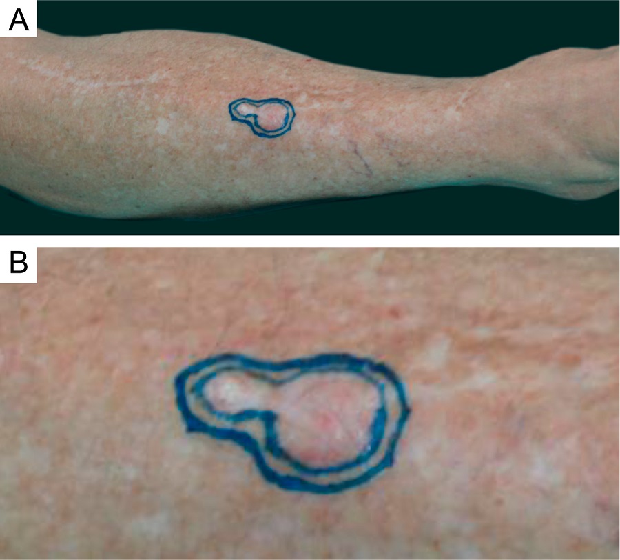 A - Carcinoma espinocelular in situ na
							perna direita. 5B - Detalhe da les&atilde;o