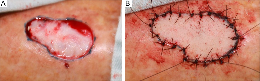 A - Defeito resultante B - Enxerto de pele
							total suturado
