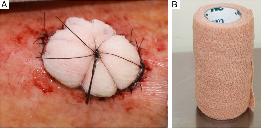 A - Enxertia de perna direita com curativo de Brown.
								7B - Rolo de atadura el&aacute;stica (Coban&reg; 3M)