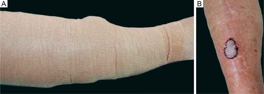 A - Faixa el&aacute;stica sobre o curativo de Brown envolvendo
							todo o segmento da perna direita. B - S&eacute;timo dia de
							p&oacute;s-operat&oacute;rio