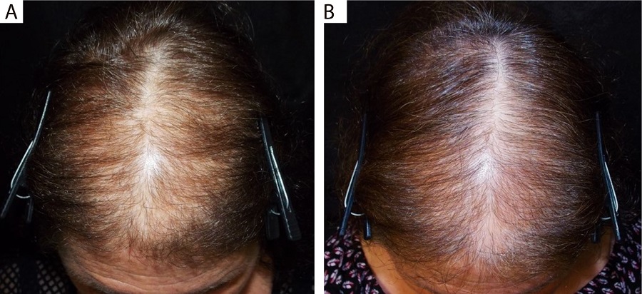 Imagem global antes (A) e após 15 dias (B)
							da última sessão de microagulhamento (total de quatro sessões)