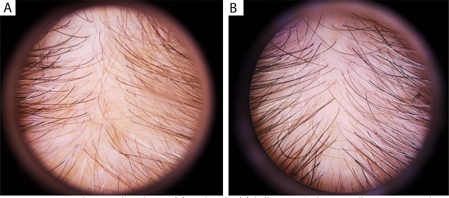 Imagem dermatoscópica de antes (A) e após 15 dias
								(B) da última sessão de microagulhamento mostrando
							aumento da densidade capilar (dermatoscópio manual, 10x)