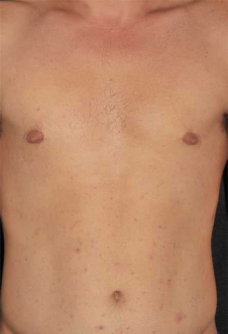 Cisto veloso eruptivo. Múltiplas pápulas eritematosas localizadas no
							tronco e abdome