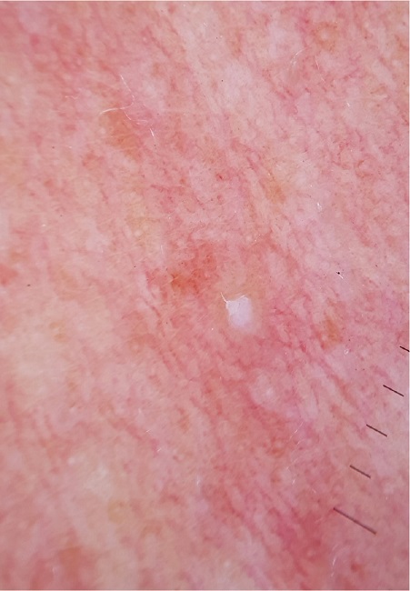 Lesão papulosa, com exulceração excêntrica e protrusão de estruturas
							filiformes (fios vellus)