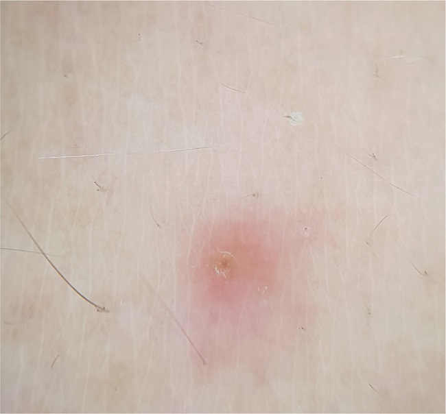 Dermatoscopia de contato do cisto veloso eruptivo. Lesão eritematosa
							ovalada, com exulceração excêntrica