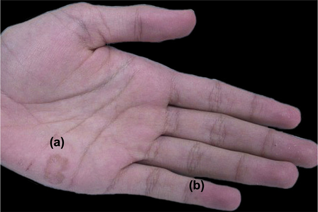 Aspecto macrosc&oacute;pico de les&atilde;o macular bem demarcada (A)
							na regi&atilde;o hipotenar da palma esquerda e nevo melanoc&iacute;tico acral
							adjacente (B) no quinto dedo esquerdo