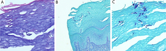 Colora&ccedil;&atilde;o de hematoxilina e eosina (H&E) da les&atilde;o macular palmar
							esquerda mostrando acantose leve e hiperqueratose (40x)
							(A), e colora&ccedil;&atilde;o de &aacute;cido peri&oacute;dico-Schiff (PAS)
							demonstrando hifas septadas positivas para PAS dentro do estrato c&oacute;rneo
							(10x) (B), (40x) (C) consistente com tinea nigra