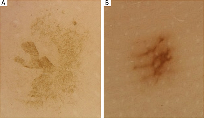 Dermatoscopia de les&atilde;o macular marrom no p&eacute; esquerdo mostrando padr&atilde;o
							de deposi&ccedil;&atilde;o de pigmento marrom-acinzentado espiculado compat&iacute;vel com
							tinea nigra (A) e de les&atilde;o marrom menor no p&eacute; direito mostrando pigmento
							depositado preferencialmente nos sulcos compat&iacute;vel com nevo melanoc&iacute;tico
							acral (B).