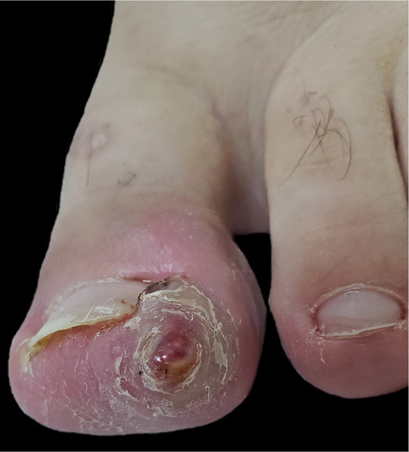 Les&atilde;o p&aacute;pulo-nodular, eritematosa, recoberta por uma pequena crosta e
							envolta por um colarete querat&oacute;tico em por&ccedil;&atilde;o distal lateral do h&aacute;lux
							esquerdo