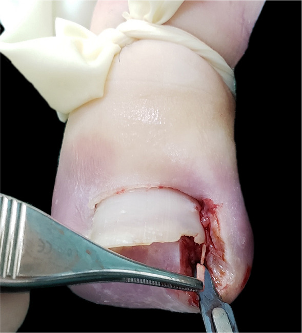 Esp&iacute;cula pontiaguda na por&ccedil;&atilde;o lateral da l&acirc;mina ungueal do h&aacute;lux
							esquerdo