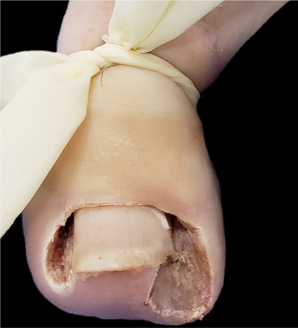 P&oacute;s-operat&oacute;rio imediato, ap&oacute;s avuls&atilde;o de faixas laterais da l&acirc;mina
							ungueal do h&aacute;lux esquerdo e cauteriza&ccedil;&atilde;o qu&iacute;mica (fenol 88%) do segmento
							lateral da matriz e da por&ccedil;&atilde;o cruenta das dobras laterais