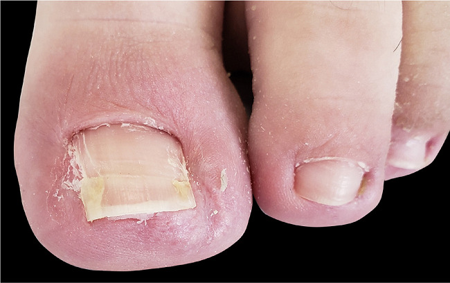 Resultado ap&oacute;s seis meses da cirurgia