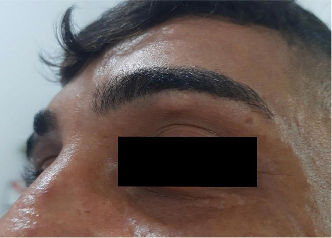 Aspecto cl&iacute;nico da p&aacute;pula palpebral esquerda em crescimento,
							apresentada pelo paciente