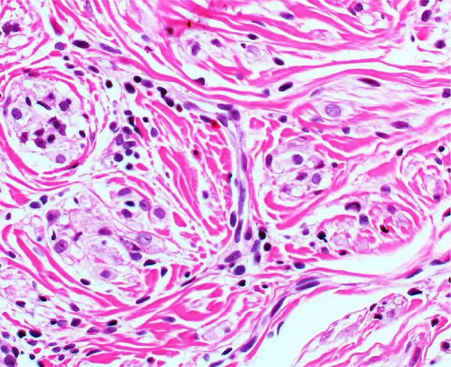 Fotomicrografia (Hematoxilina & eosina, 200x) de c&eacute;lulas
							epitelioides e fusiformes com certo grau de polimorfismo nuclear e
							hipercromasia, distribu&iacute;das difusamente por entre fibras
							col&aacute;genas