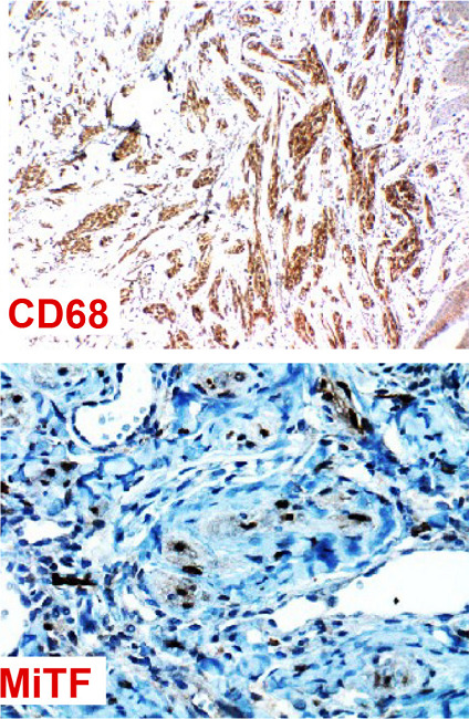 Neurotecoma. Marca&ccedil;&atilde;o por imuno-histoqu&iacute;mica: CD68 e MiTF