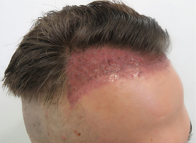 Opção pelo corte estilo militar no tratamento com dense packing
								das entradas