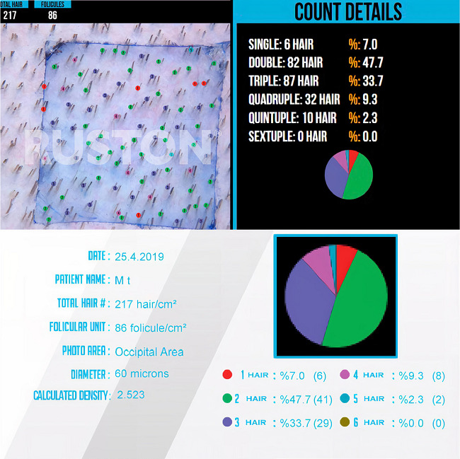Hair Counter Software: análise da região doadora
								occipital