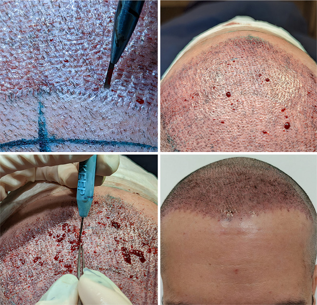 Incisões prévias com microlâminas personalizadas em toda a área
								receptora. Utilização do KEEP para colocação dos enxertos com menor
								trauma aos bulbos, e resultado no dia seguinte ao procedimento, após
								a lavagem realizada na clínica