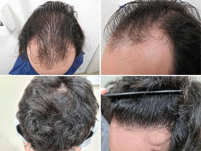 Resultado final após um ano do procedimento, com 3.654 unidades
								foliculares. Resolução da frente e melhora do meio e coroa. Foi
								realizado tratamento clínico associado