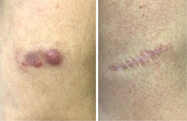 À esquerda, pápulas e nódulos túmidos agrupados em placa, na região
distal do braço esquerdo, de linfoma cutâneo primário de células B da
zona marginal. À direita, após tratamento, ausência de recidiva após 36
meses de seguimento