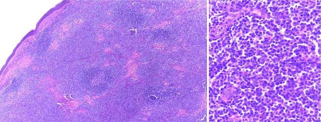 À esquerda, infiltração linfocitária difusa da derme, com áreas mais
pálidas irregulares, e esparsos pequenos folículos reacionais mais
escuros, por vezes com centro germinativo (Hematoxilina & eosina,
40x). À direita, maior aumento, evidenciando linfócitos de volume
predominantemente pequeno a médio, e frequentes células
linfoplasmocitoides (Hematoxilina & eosina, 400x)