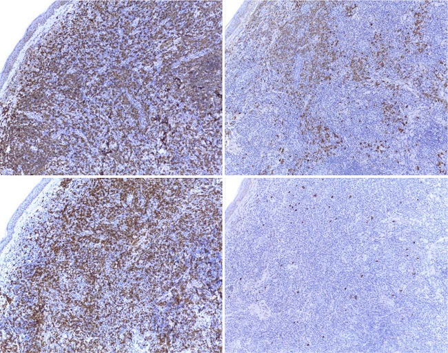 Imuno-histoquímica com os marcadores CD20 (acima à esquerda), CD3
(abaixo à esquerda), kappa (acima à direita) e
lambda (abaixo à direita), evidenciando infiltração
linfocitária mista, com populações de imunofenótipo B ou T, e restrição
de cadeias leves de imunoglobulina com predomínio de expressão de
kappa