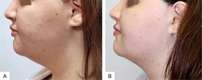 Lipoaspiração da gordura do submento: antes (A) e
								depois (B)
