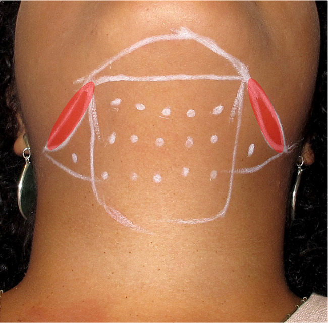 Demarcação para o tratamento da gordura submental com
								lipolíticos