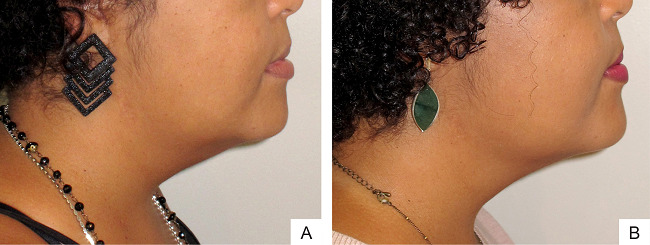Tratamento da gordura do submento com lipolíticos: antes
									(A) e depois (B) - quatro sessões com
								intervalos de 30 dias