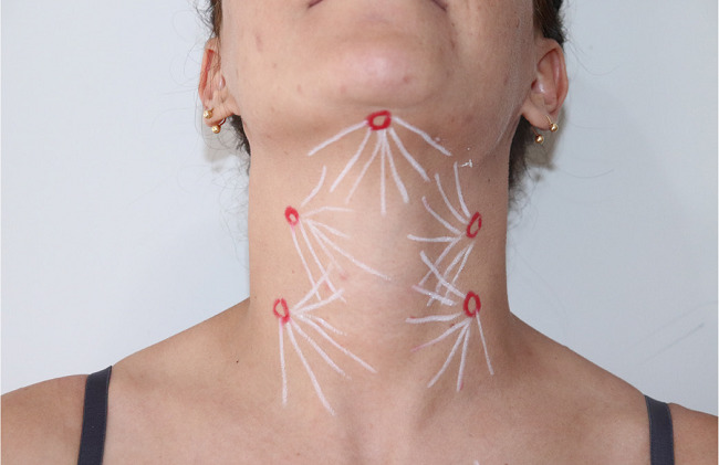Demarcação da aplicação de hidroxiapatita de cálcio no pescoço na
								diluição de 1:4 com emprego de figuras vetorizadas