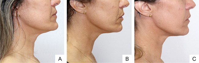 Tratamento da flacidez cutânea submental com hidroxiapatita de
								cálcio. Uma seringa por sessão. Total de duas sessões.
									A - pré-tratamento; B - uma
								sessão; e C - duas sessões (observar a adequada retração de
								pele)