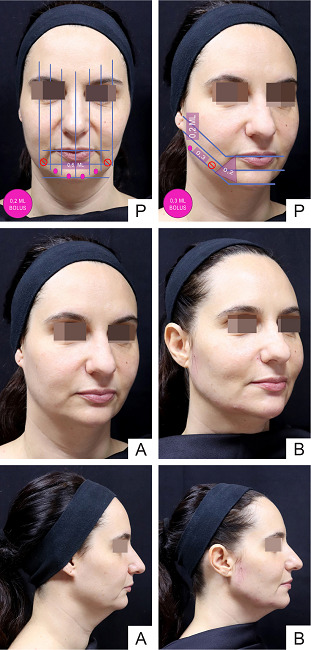 Perda de definição do contorno do submento de origem estrutural.
									P - programação do tratamento com preenchedor de
								ácido hialurônico. Antes (A) e depois
								(B)